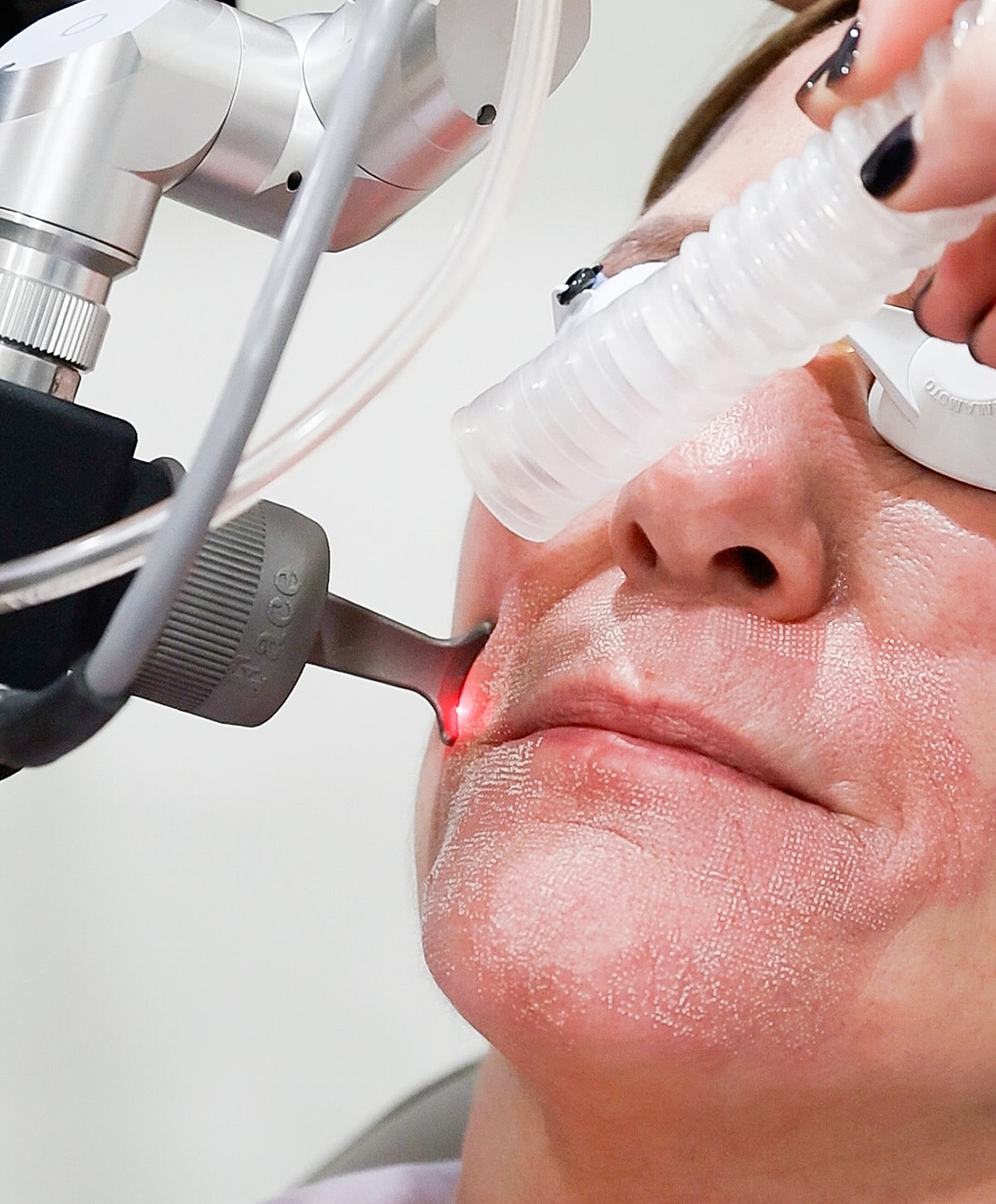 Laser facial treatment in progress on patient.