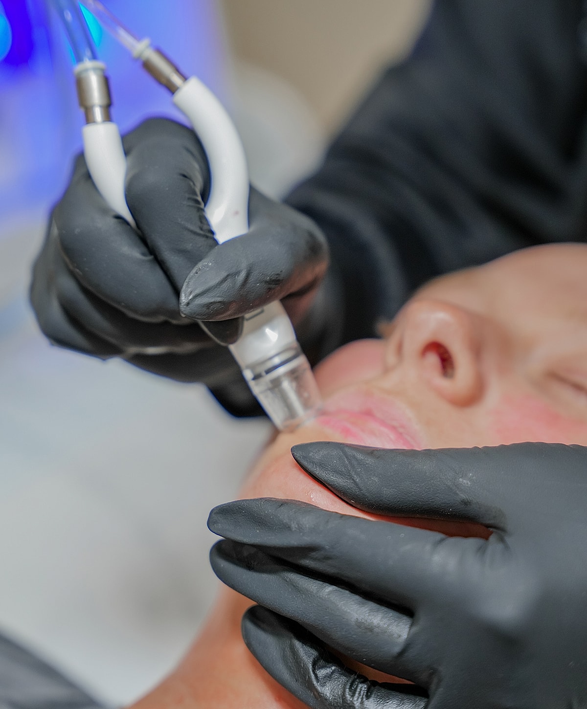 Facial treatment with microneedling device in progress.