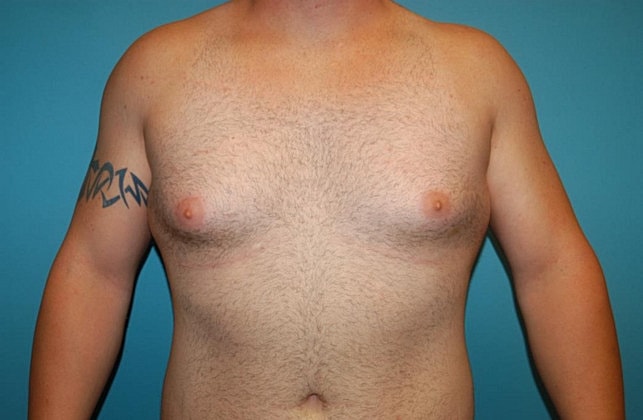 Gynecomastia Before & After