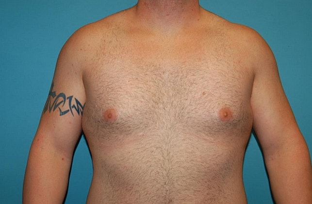 Gynecomastia Before & After