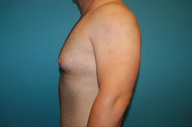 Gynecomastia Before & After