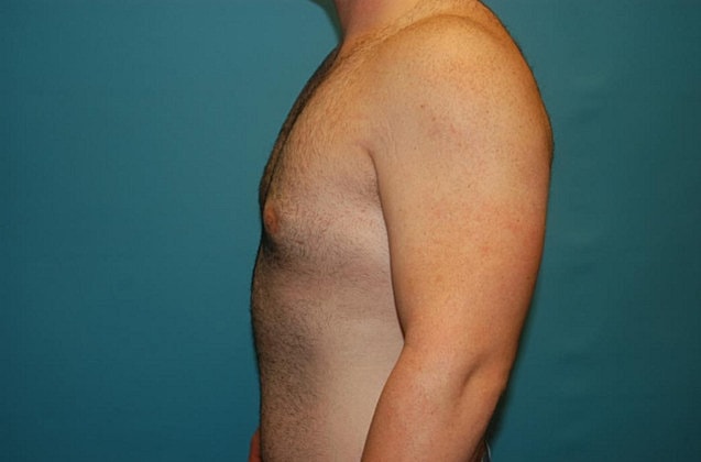 Gynecomastia Before & After