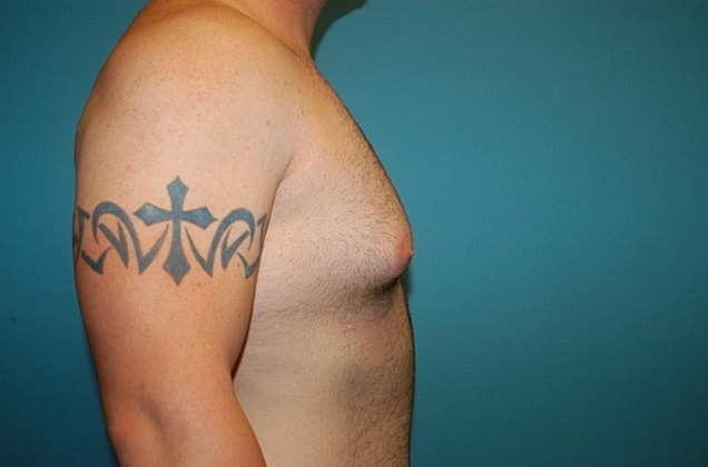 Gynecomastia Before & After