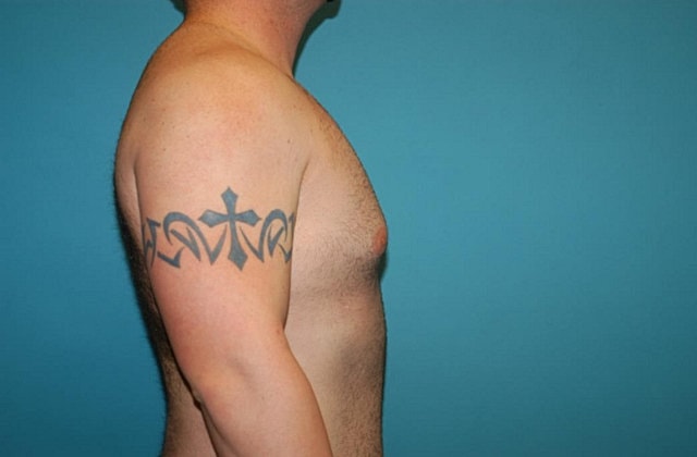 Gynecomastia Before & After