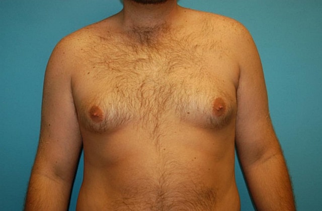 Gynecomastia Before & After
