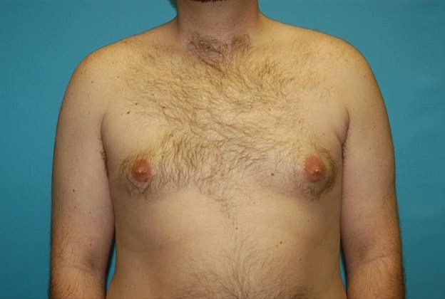 Gynecomastia Before & After