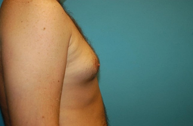 Gynecomastia Before & After