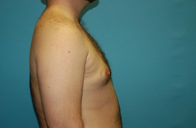 Gynecomastia Before & After