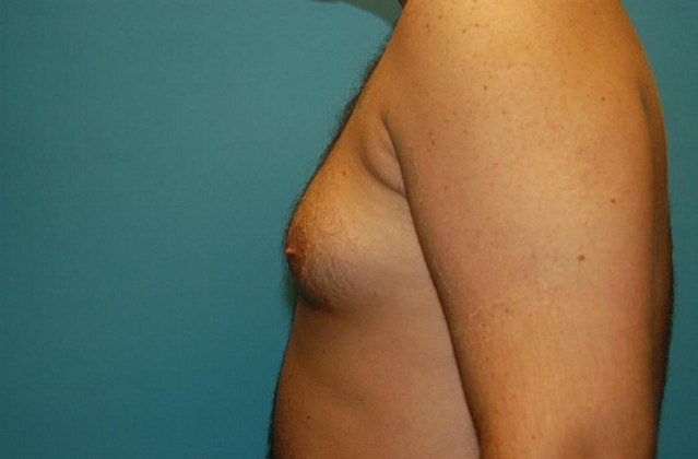 Gynecomastia Before & After