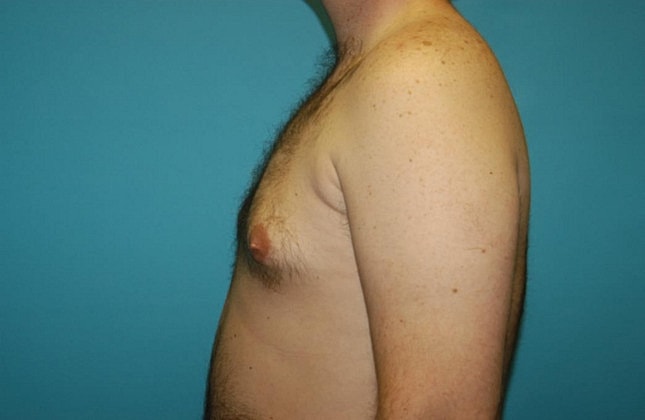 Gynecomastia Before & After