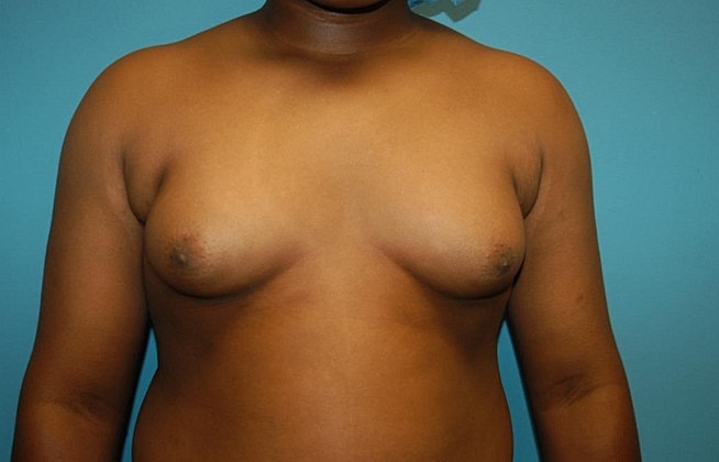 Gynecomastia Before & After