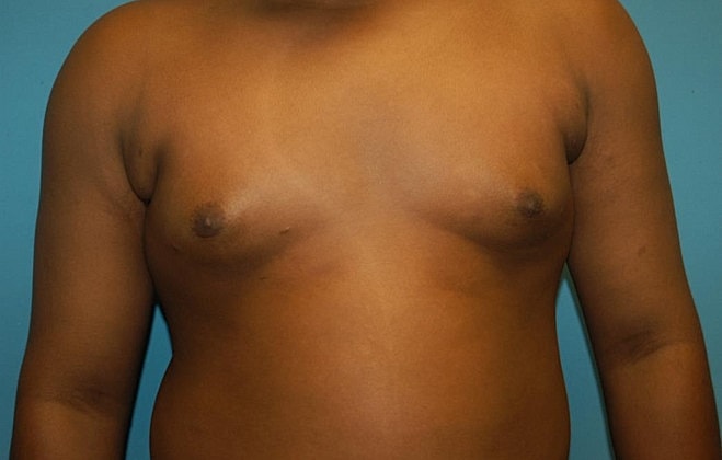 Gynecomastia Before & After