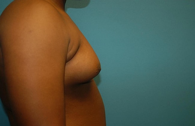Gynecomastia Before & After