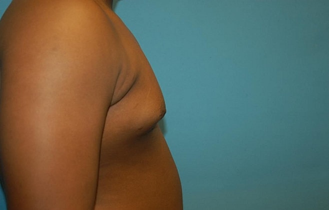Gynecomastia Before & After