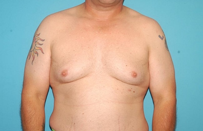 Gynecomastia Before & After