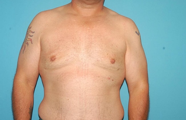 Gynecomastia Before & After