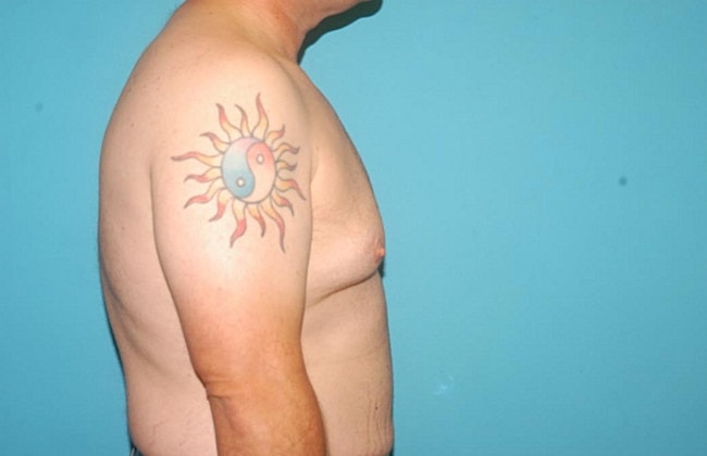 Gynecomastia Before & After