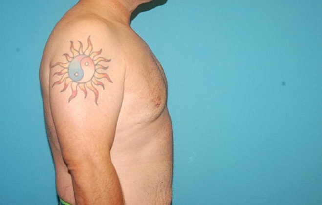 Gynecomastia Before & After