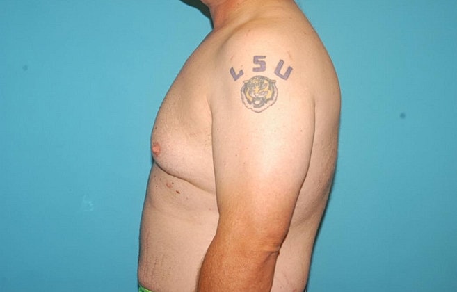Gynecomastia Before & After