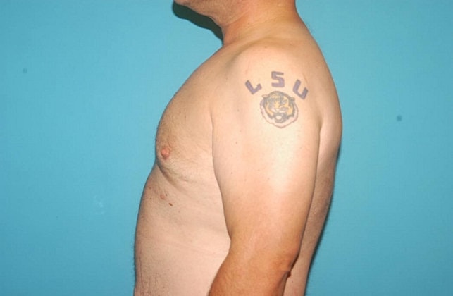 Gynecomastia Before & After