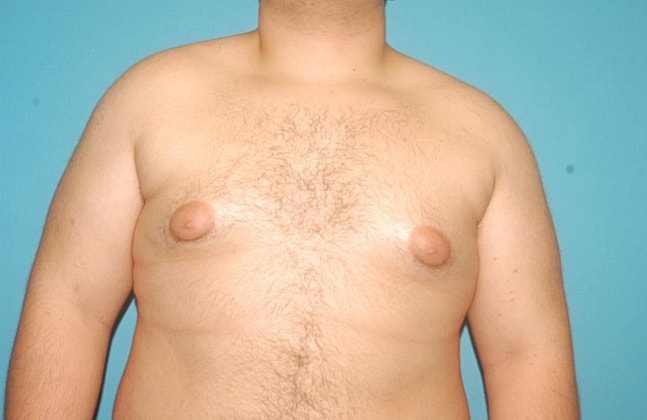 Gynecomastia Before & After