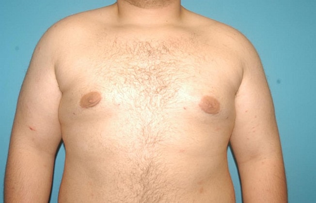 Gynecomastia Before & After