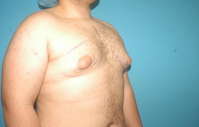 Gynecomastia Before & After
