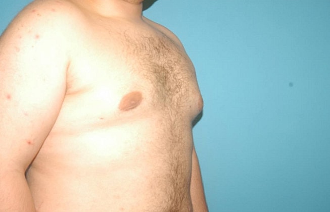 Gynecomastia Before & After
