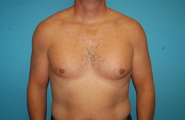 Gynecomastia Before & After