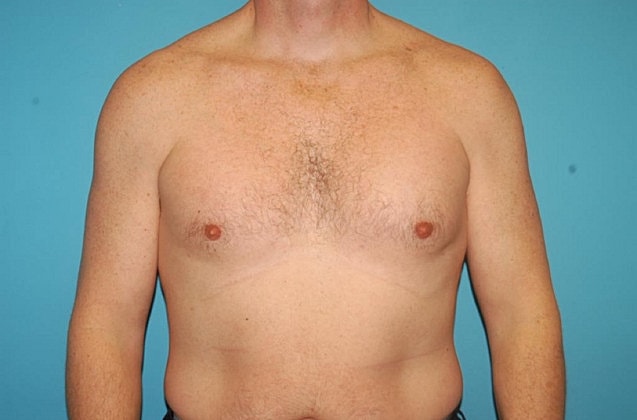 Gynecomastia Before & After