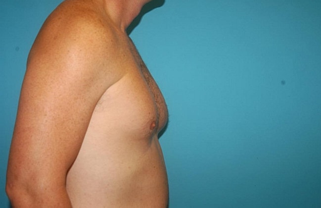 Gynecomastia Before & After