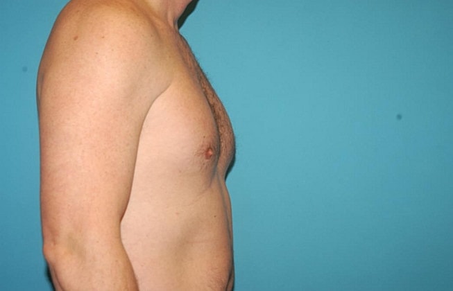 Gynecomastia Before & After