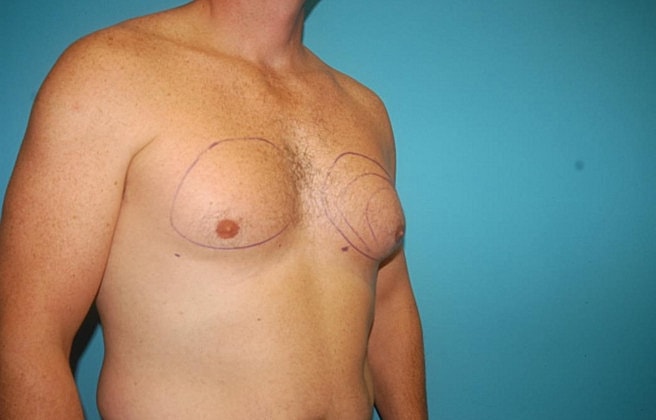 Gynecomastia Before & After