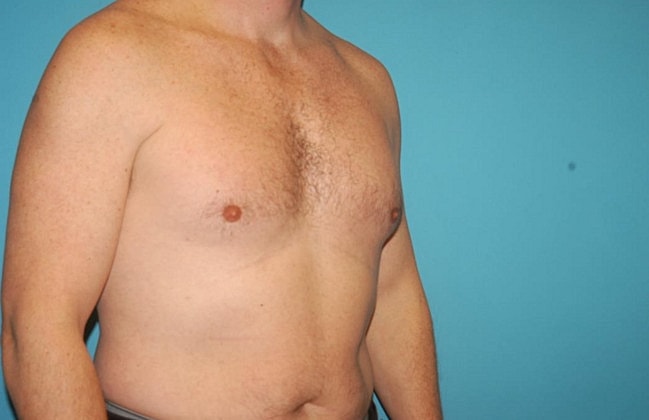 Gynecomastia Before & After