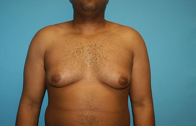Gynecomastia Before & After