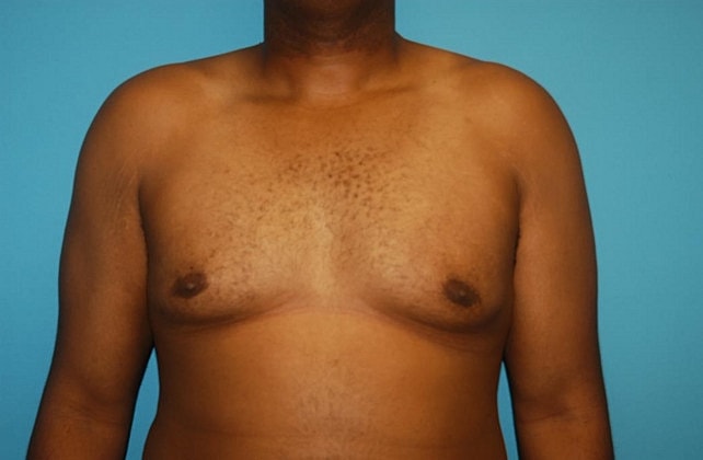 Gynecomastia Before & After
