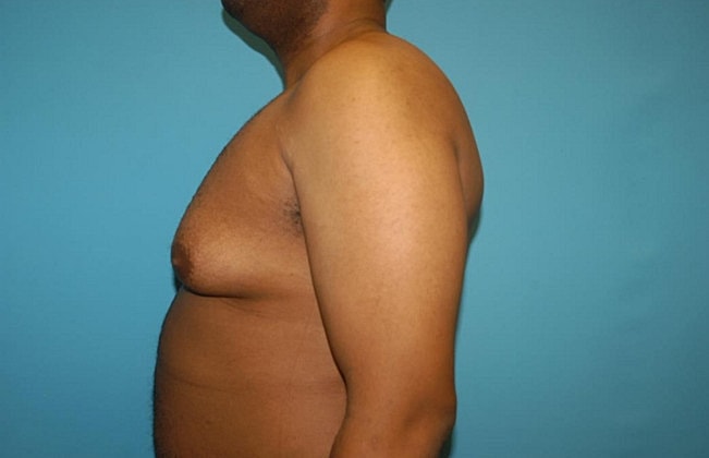 Gynecomastia Before & After