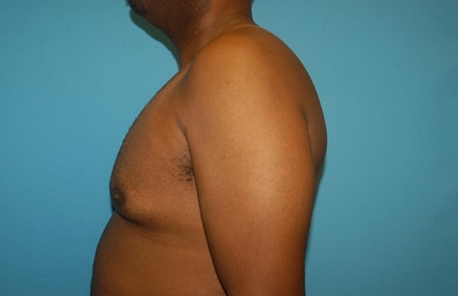 Gynecomastia Before & After