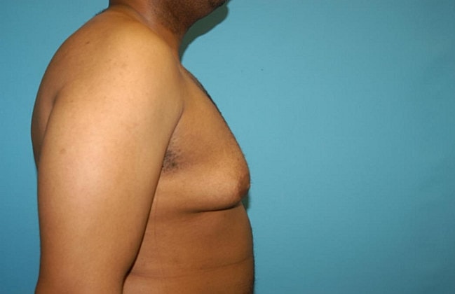 Gynecomastia Before & After