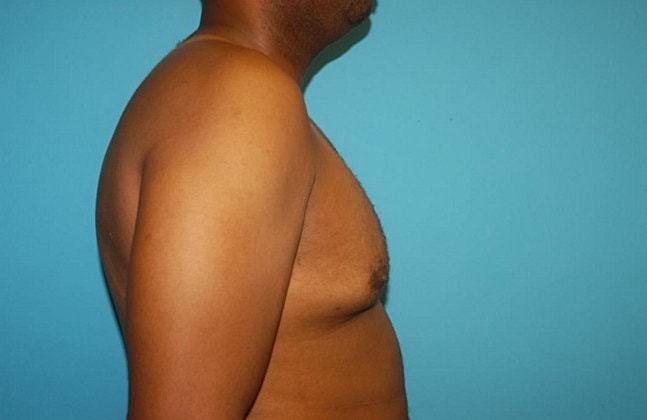 Gynecomastia Before & After