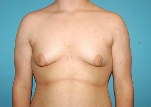 Gynecomastia Before & After