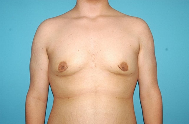 Gynecomastia Before & After