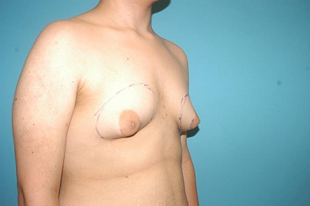 Gynecomastia Before & After