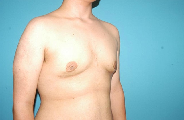 Gynecomastia Before & After