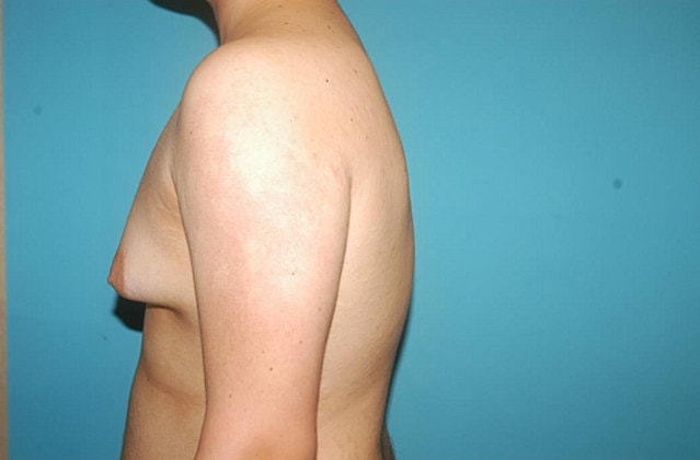 Gynecomastia Before & After