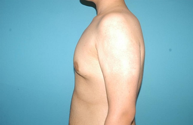 Gynecomastia Before & After