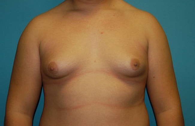 Gynecomastia Before & After