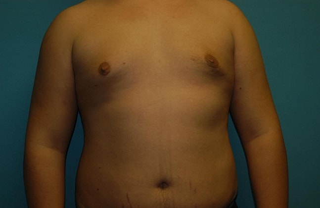 Gynecomastia Before & After