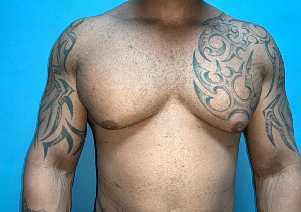 Gynecomastia Before & After