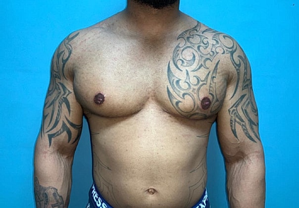 Gynecomastia Before & After